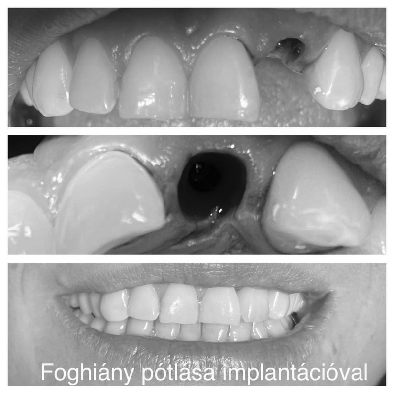 Egy másik mai munkám az InNovadent Fogtechnika- val : Zsuzsanna Nógrádi és
Olivér Vajda- val.
Egy gyönyörű hölgy álomszép mosolya.
QueenDent
Orvosi munka : drAndrea Urbán
Foghúzás utáni azonnali implantáció gyógyulás utáni cirkon- kerámia koronával való pótlása